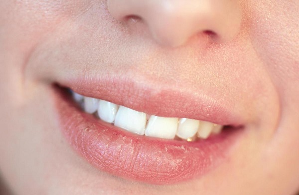 How to Avoid Chapped Lips